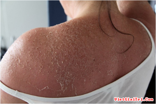 Ung thư biểu mô tế bào vảy - Hình ảnh minh họa